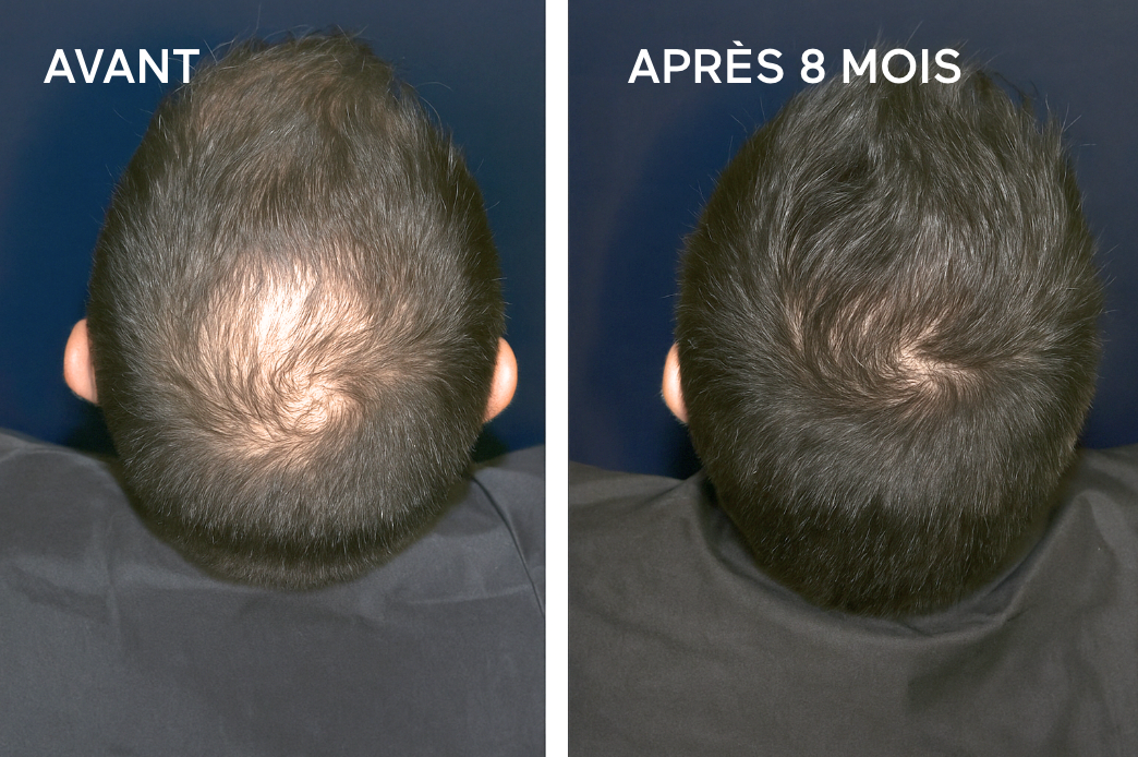 Avant Après veuch