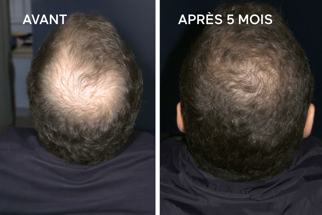 Avant Après veuch