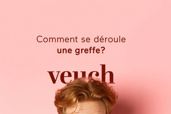 Comment se déroule une greffe de cheveux ?